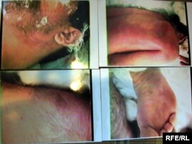 Evidence of torture in Azerbaijani prisons obtained by RFE/RL