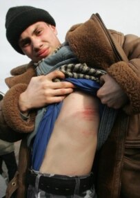 Mikhal Audzeyeu, who has been protesting on October Square, says he was beaten by the police and shows his bruises (RFE/RL)