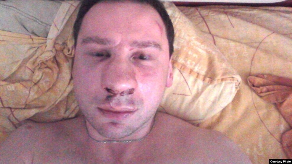 Избитый оппозиционный активист Егор Алексеев