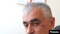 RFE/RL's Hrach Melkumian, who was beaten by an unknown assailant in Yerevan this week.