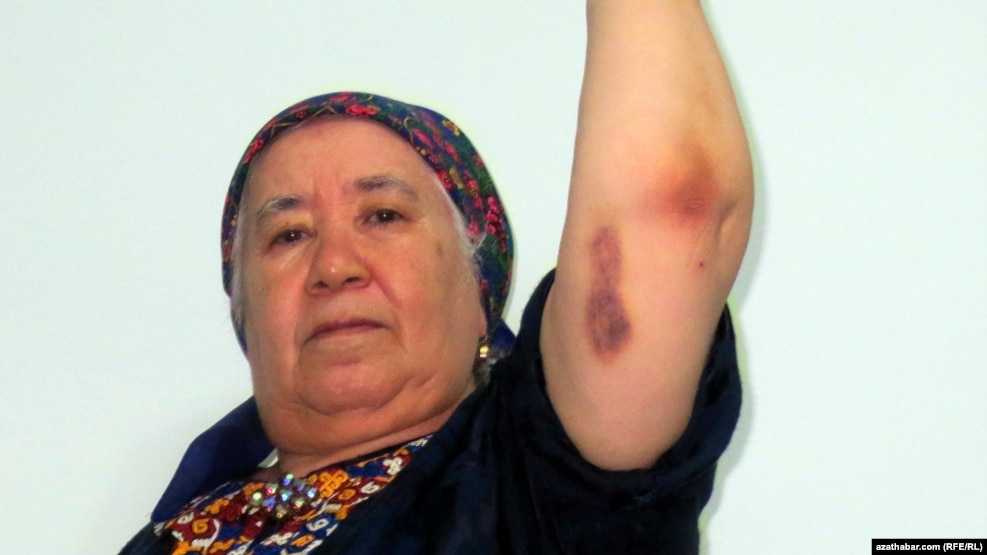 RFE/RL Turkmen Service correspondent Soltan Achilova displays some of the bruises she suffered during an attack in late October in Ashgabat.