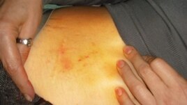 An image released by ombudsman Nina Karpachova after she visited Yulia Tymoshenko, showing bruises on her abdomen