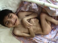 An emaciated child, starving and near death, at the adult psychiatric facility in Braila (MDRI)