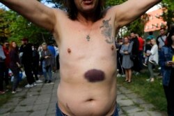 Чоловік показує забої, за його словами, внаслідок побиття в міліції, після звільнення з центру тримання в Мінську в серпні