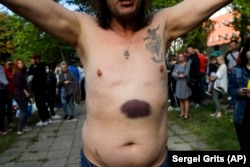 A man shows bruises he says were left by a police beating after being released from a detention center in Minsk in August.