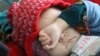 آرشیف، یک کودک مبتلا به سوء تغذیه در افغانستان