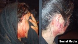 زنانی که در تجمع مقابل زندان قزلحصار کرج به دست نیروهای امنیتی جمهوری اسلامی زخمی شدند؛ عکس: شبکه‌های اجتماعی
