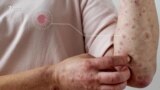 Быйыл кызылчадан үч бала чарчап калды