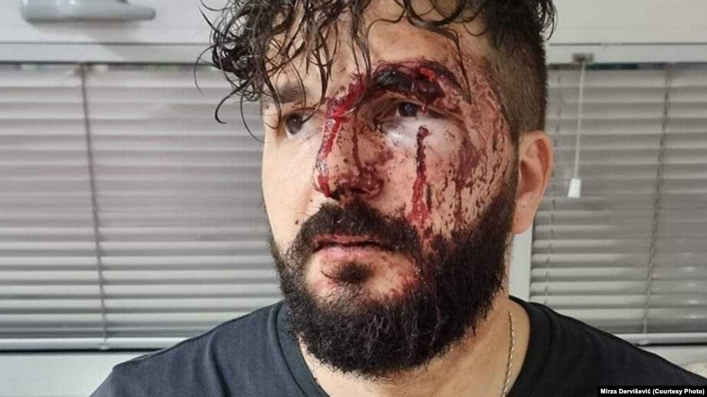 Mirza Dervišević, novinar i urednik iz Brčkog, nakon napada metalnim bokserom 19. avgusta 2023. godine. Tužilaštvo još uvijek nije podiglo optužnicu protiv napadača.
(Foto: Facebook)