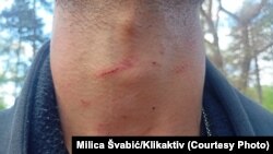 Ogrebotine na vratu jednog od mladića iz Sirije, 27. april 2023, Sombor