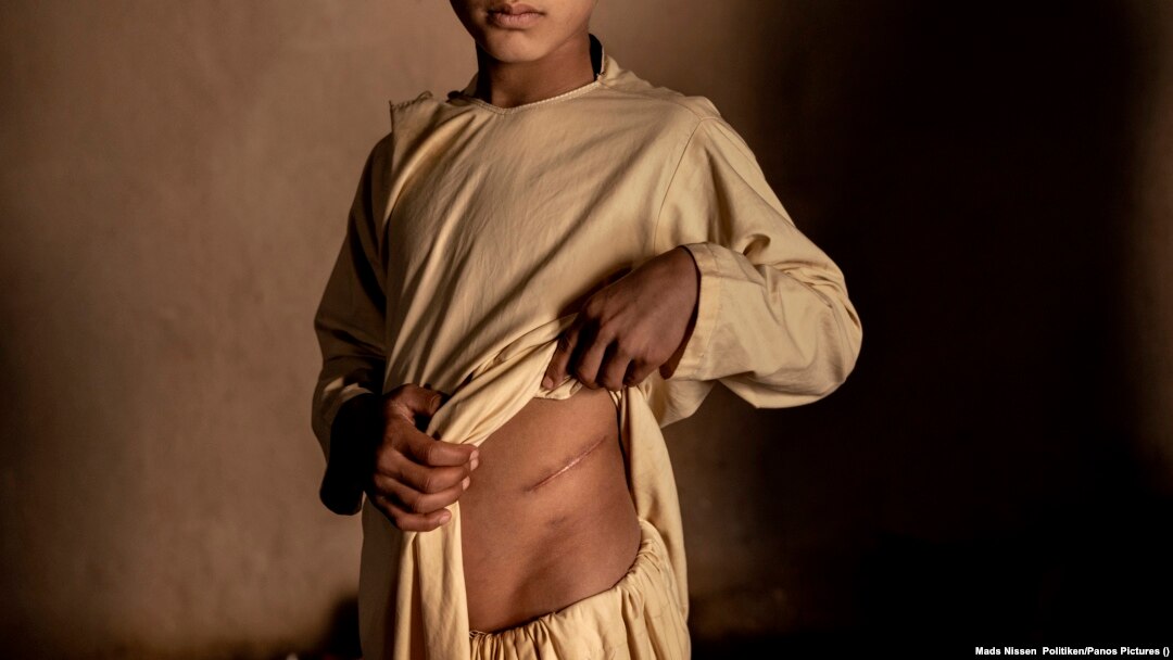 In Afghanistan, widespread poverty has fueled an illegal organ trade, especially for kidneys. (file photo)