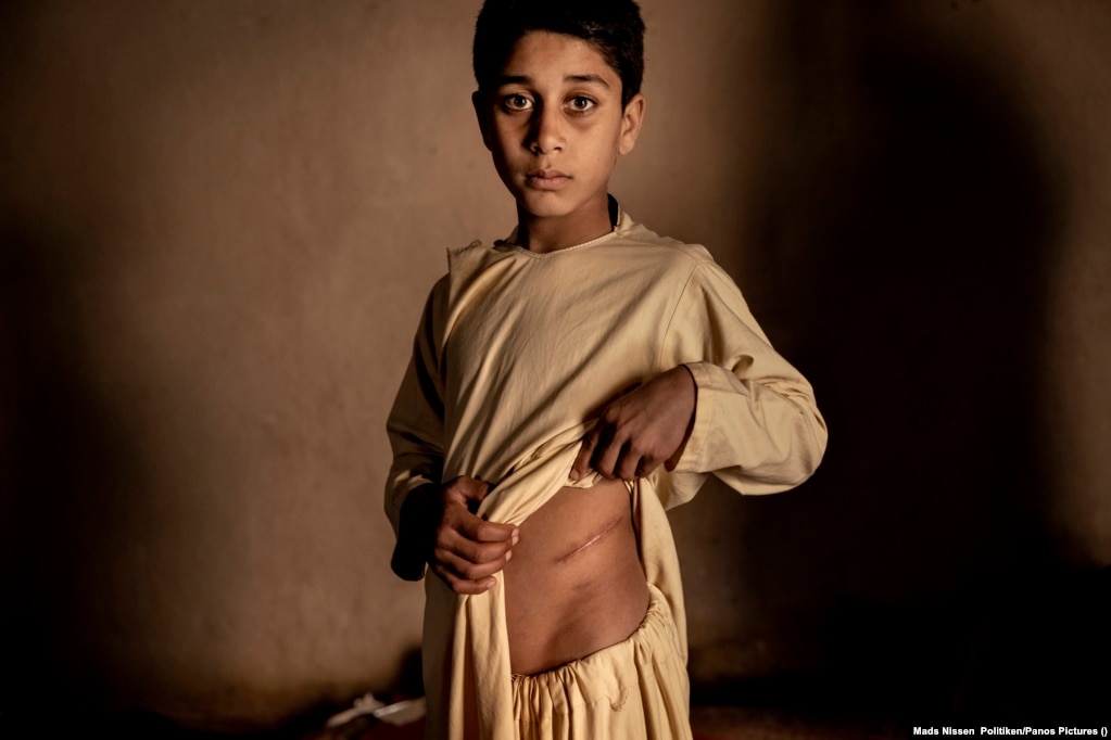 Khalil Ahmad, 15-vjeçar, i fotografuar më 19 janar 2022, shihet në Herat të Afganistanit, pak pasi prindërit e tij ia kanë shitur veshkën për 3.500 dollarë amerikanë, për të blerë ushqime për familjen. Mungesa e vendeve të punës dhe vështirësitë ekonomike, kanë ndikuar në rritje të tregtisë ilegale me organe në Afganistan. Gazetari Mads Nissen nga Politiken/Panos Pictures&nbsp;është shpërblyer për temën, Çmimi i Paqes në Afganistan, të cilën e ka treguar përmes disa fotografive.