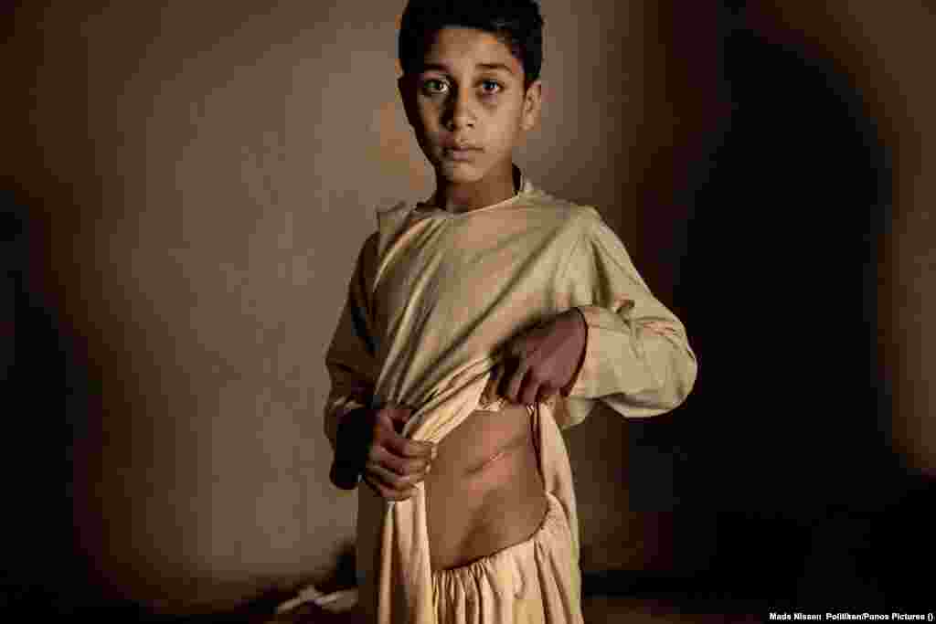 A 15 éves Khalil Ahmad pózol a Politiken fotósának, Mads Nissen kamerája előtt 2022. január 19-én az afganisztáni Heratban, miután szülei 3500 dollárért eladták a veséjét, hogy a családnak legyen pénze élelemre. A munkanélküliség és az éhezés miatt drámai mértékben megnőtt az illegális szervkereskedelem Afganisztánban. A béke ára Afganisztánban&nbsp;(Mads Nissen, Politiken/Panos Pictures) &ndash; World Press Photo:&nbsp; Az év riportja
