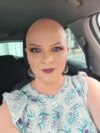 Katerina Andova, patient with alopecia