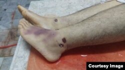 این تصویر آثار ضرب و جرح، و کبودی پاهای پیمان گلوانی را نشان می‌دهد