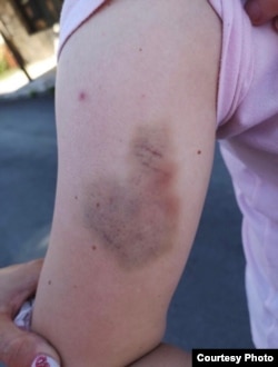 A bruise on Zivkovic's arm that she says she got during the altercation.
