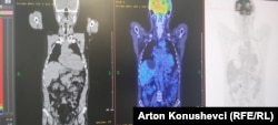 Imazhi nga skanimi me PET/CT.