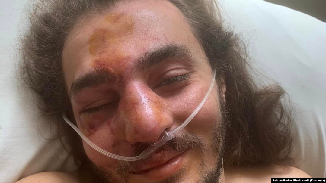 Georgian civil activist Zuka Berdzenishvilli recovers after he said he was attacked on June 11.