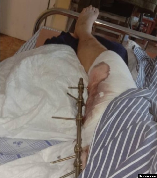 Нога Владимира Фролова после операции с аппаратом КСТ