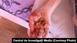 Следи от насилие по ръката на възрастен човек, документирани от журналистическото разследване, публикувано в началото на годината.