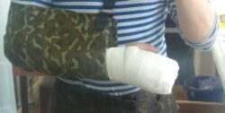 Сломанная рука Игоря, военного из Забайкалья, не получившего выплаты