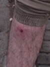 Tbilisi, Georgia -- A close-up of an alleged rubber bullet wound inflicted by the police