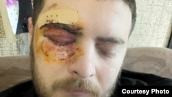 Nika Demurishvili, 24, suffered a wound around his right eye during the May 1 rally in the Georgian capital.