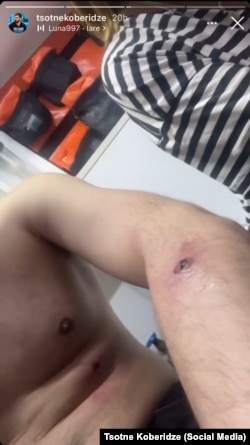 Tsotne Koberidze said he was hit with two rubber bullets at the same time on May 1.