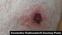Konstantine Chakhunashvili shows the wounds he says were caused by rubber bullets.