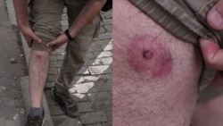 Injured Reporter Says Georgian Police Used Rubber Bullets Against Protesters 