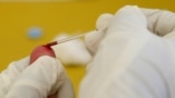 Testimi dhe terapia për HIV në QKUK, ashtu sikurse edhe në institucionet tjera publike të Kosovës, ofrohen falas.