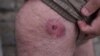Georgia - a journalist shows an injury that he says is from a police officer's rubber bullet during protests - screen grab
