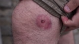 Georgia - a journalist shows an injury that he says is from a police officer's rubber bullet during protests - screen grab