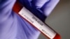 Франція: зафіксовано п’ятий випадок захворювання на новий коронавірус