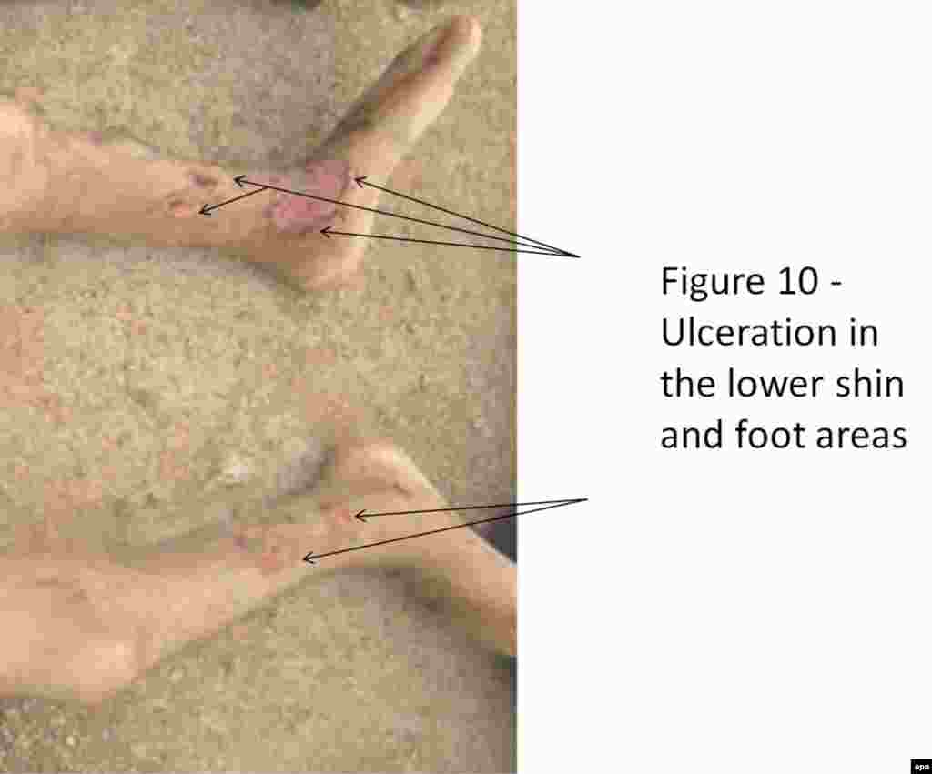 An undated photograph showing ulceration on the lower shin and foot areas of a person.
