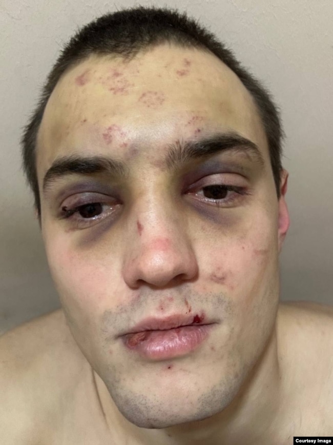 Артем Быков после одного из избиений