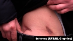 Сергей Мак показывает шрамы, оставшиеся на его теле после пулевого ранения