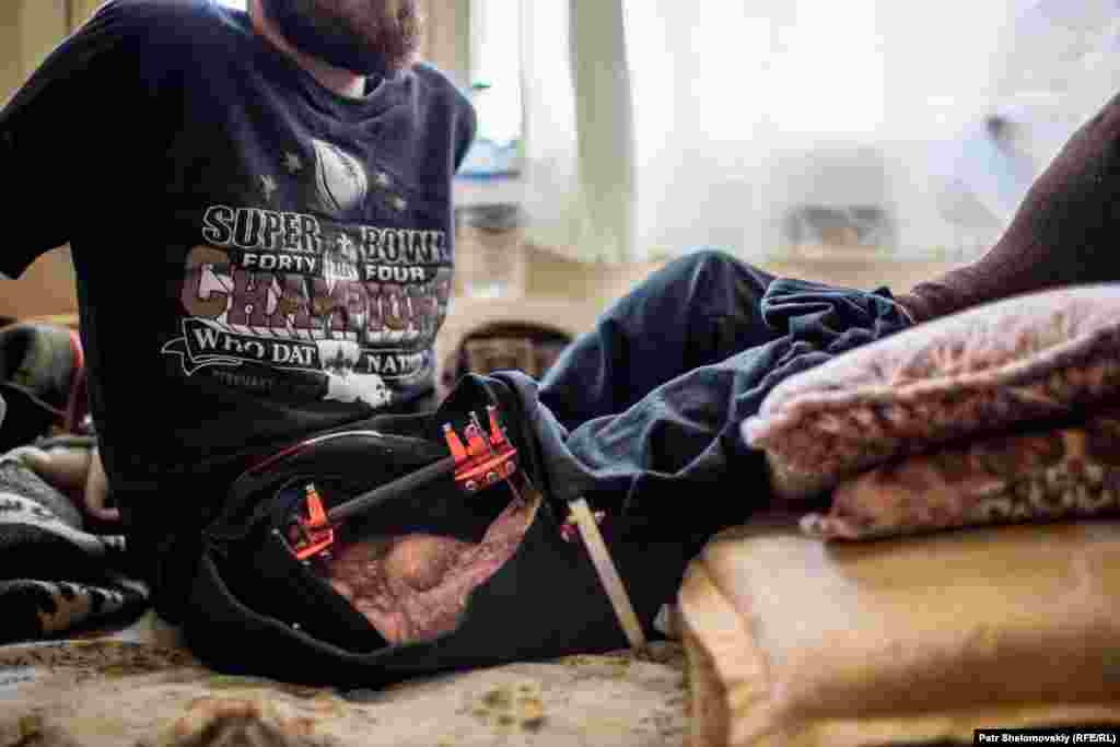 Abu Alwaled Altefy from Aleppo. The 23-year old says he was badly wounded 18 months ago while fighting Syrian government forces. The metal rods are due to be removed from his leg soon, but he will never walk normally again. 