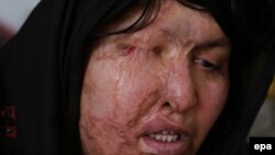 Pamje e një gruaje e sulmuar me acid