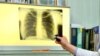 ВООЗ: у Європі зростає смертність від туберкульозу, Україна – серед «лідерів»
