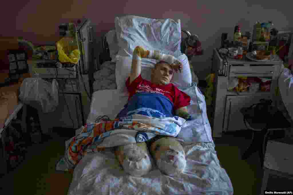 A 22 éves Anton Gladun fekszik kórházi ágyában Cserkasziban 2022. május 5-én. A kelet-ukrajnai frontvonalon szolgálatot teljesítő katonaorvos március 27-én egy aknarobbanás következtében vesztette el mindkét lábát és bal karját