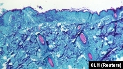 Secțiune într-un țesut prelevat dintr-o leziune din pielea unei maimuțe infectată cu virusul variolei maimuței.