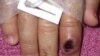 Egy 2003-as archív fotó egy fertőzött ujjról