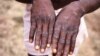 Африкадағы Конго мемлекетінде 1996-1997 жылдары маймыл шешек өршіген кезде түсірілген суретте науқас бөрткен басқан қолын көрсетіп тұр. Архивтегі фото.