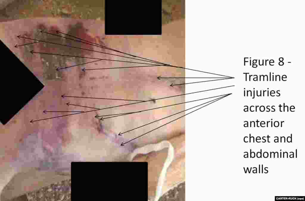 An undated photograph showing injuries across a person's chest and adominal wall.