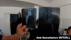 Мубара Айтибаеванын буту тартылган рентгендин сүрөтү. Анын эки кашка жилиги чирип, анын ордуна протез коюлган.
