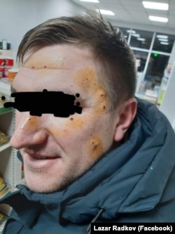 Eдин от украинците, в чието лице са се забили осколки. Още в началото на войната той е изпратил бременната си съпруга и двете им деца на сигурно място в Западна Украйна и оттогава е доброволец