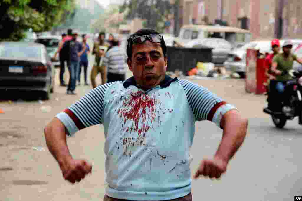 Povređeni demonstrant nakon sukoba Morsijevih pristalica i oponenata u Kairu