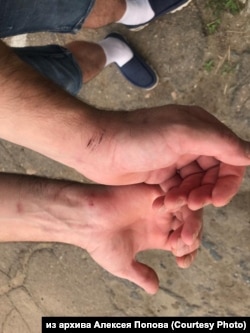 Травмы спасателя Алексея Попова после задержания росгвардейцами