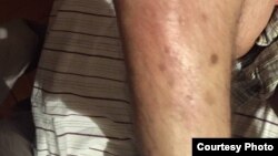 Mehman Hüseynov. İşgəncə izləri. 11yan2017